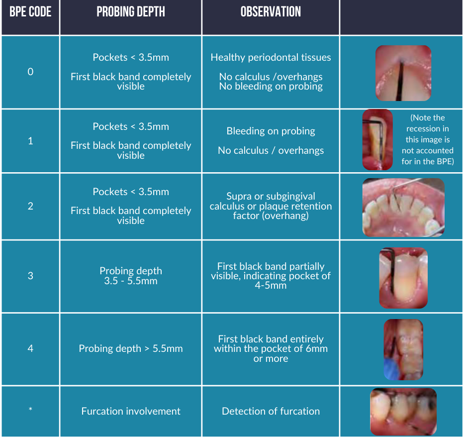 British Society of Periodontology table showing the codes and what they represent.