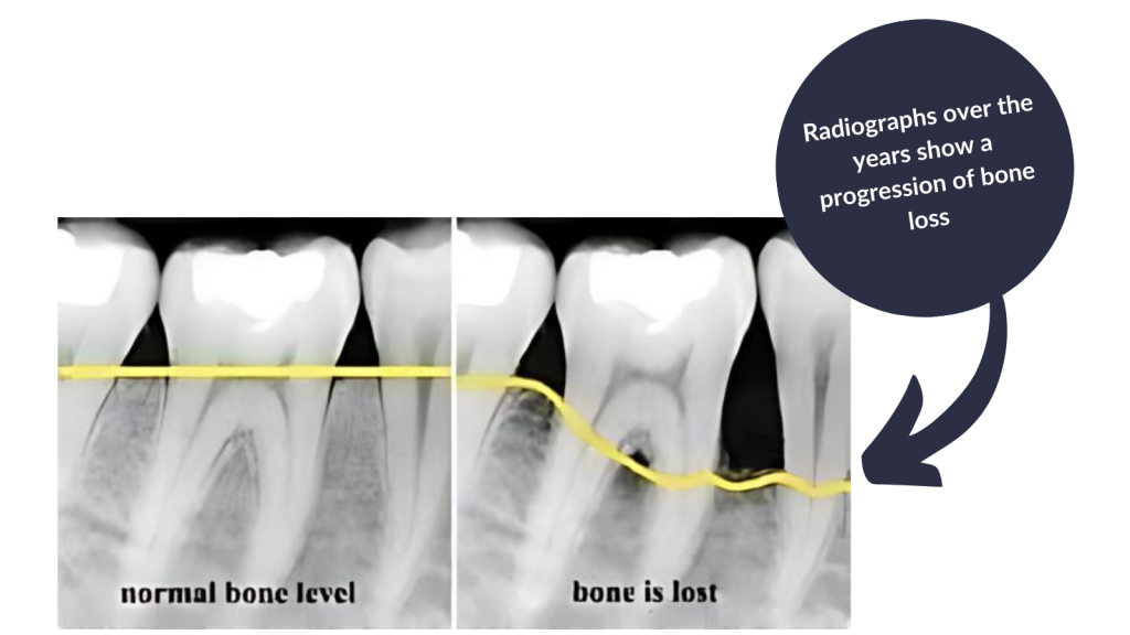 Radiograph illustrating the progression of bone loss from periodontal disease.